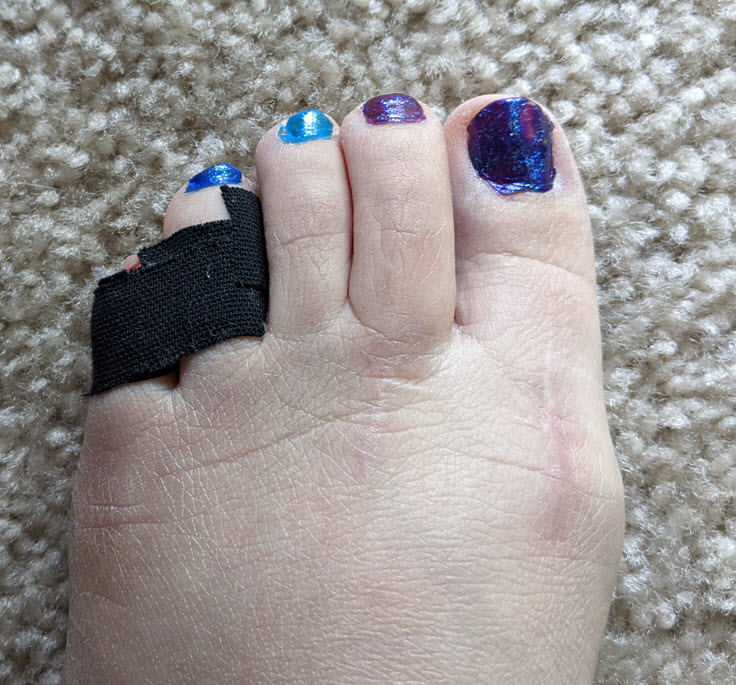 Picture of a left foot on a beige carpet. The two smallest toes are taped together. All of the visible toes are swollen and the foot is swollen. The two largest toes have faint vertical scars. The two largest toenails are painted purple, the middle nail is painted electric blue, and the fourth is painted bright blue. All toenails have a layer of gold glitter nail polish on them. The smallest toenail is not visible because of the tape.